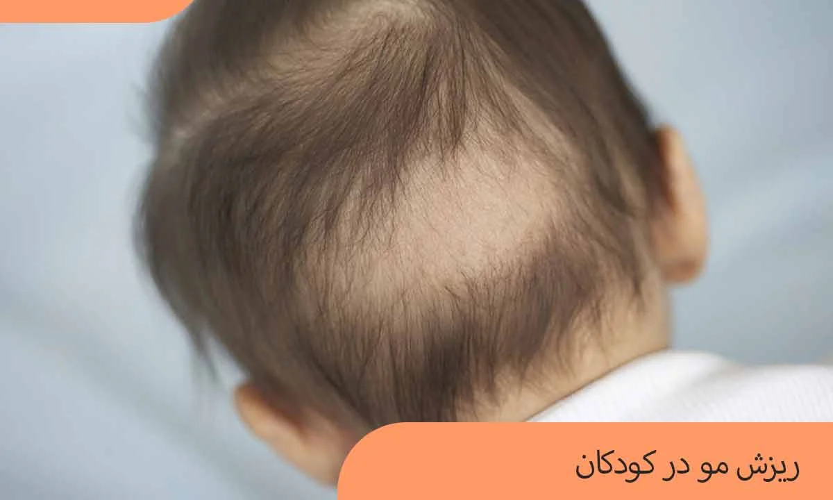 ریزش مو در کودکان: علل، درمان ها و پیشگیری