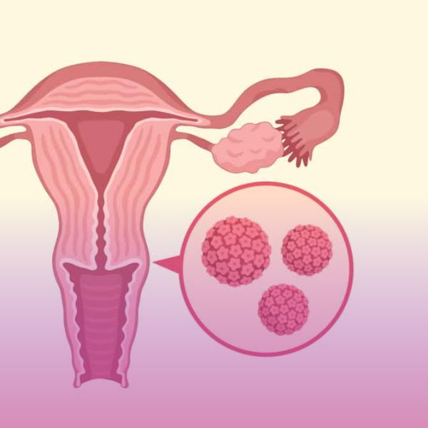 بهداشت فردی برای زگیل تناسلی