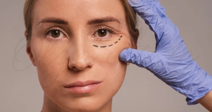 افتادگی پلک بعد از بوتاکس